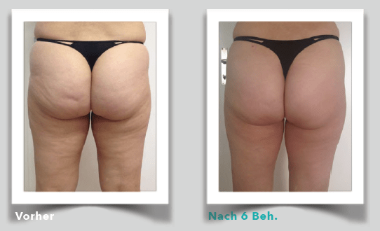 Körpermodellierung