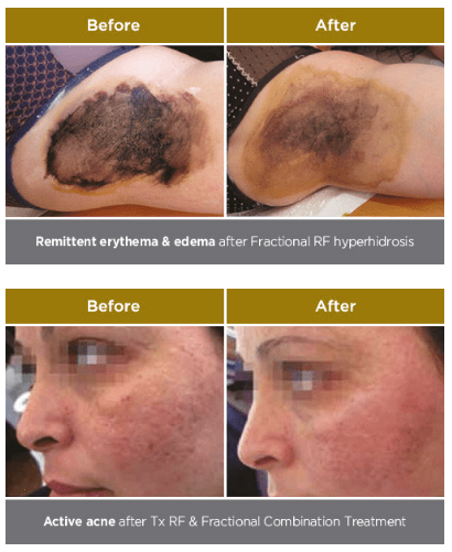 Remittent erythema & after Fractional RF hyperhidrosis
