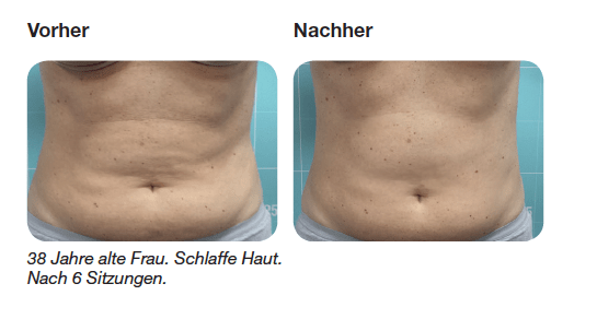 vorher/nachher