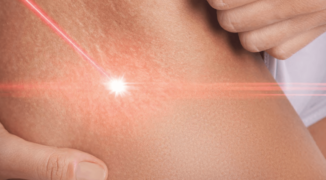 Das fraktionierte Laserverfahren