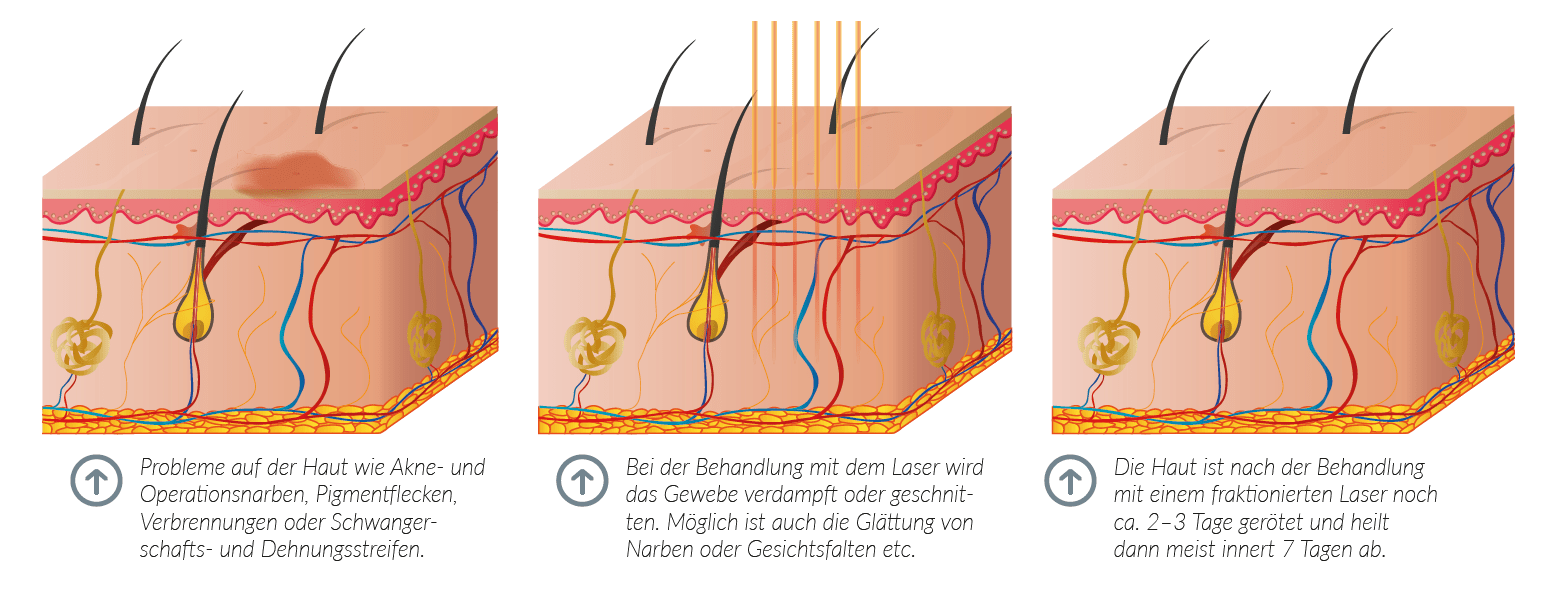 WAS SIND MÖGLICHE KOMPLIKATIONEN UND NEBENWIRKUNGEN?