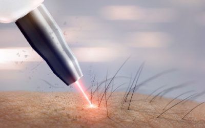 So funktioniert der Haarlaser